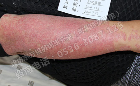 醫生介紹銀屑病的危害是什么