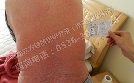 小孩營養(yǎng)不良引起銀屑病會有哪些危害