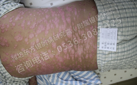 銀屑病不護(hù)理還能恢復(fù)嗎