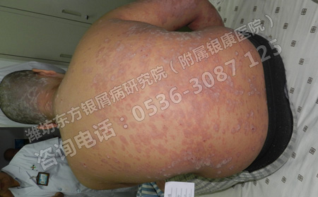 銀屑病蔓延到背部該怎么辦呢