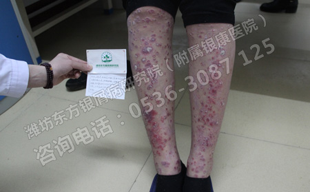 青少年得了銀屑病會影響他們的心理健康嗎