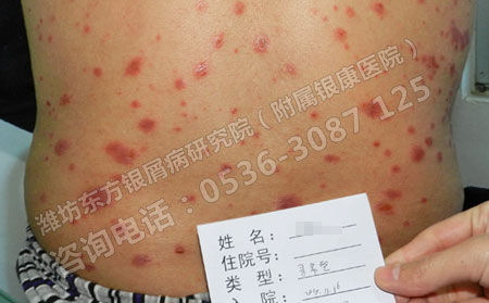 濟南牛皮癬醫院中醫治療的優勢