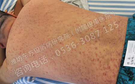 治療銀屑病效果比較理想的方法有哪些