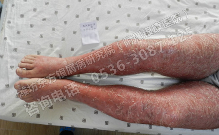 得了銀屑病會對身體產生非常嚴重的危害嗎