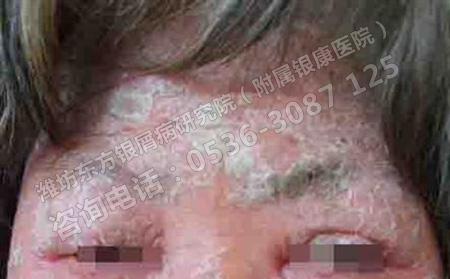女性得了銀屑病會對胎兒產(chǎn)生哪些影響