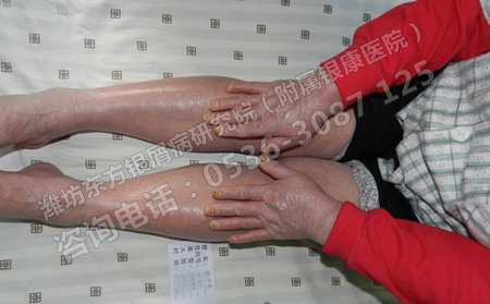 銀屑病患者一定要了解的疾病預防常識