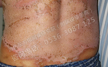 專業醫院是怎樣治療銀屑病的