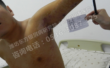 濟南預防銀屑病有沒有比較理想的方法呢