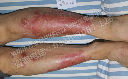 腿上的牛皮癬印記夏天怎么去除