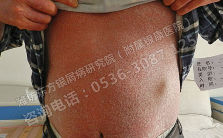 濟南治療牛皮癬去哪家醫院