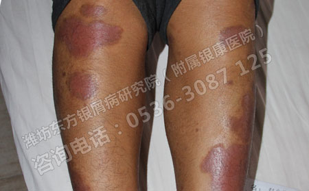 女性牛皮癬患者的夏天護(hù)膚方法