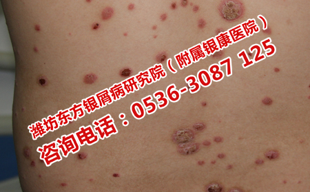 如何治療重癥牛皮癬