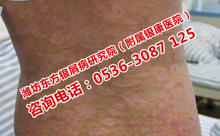 尋常型牛皮癬要早治療