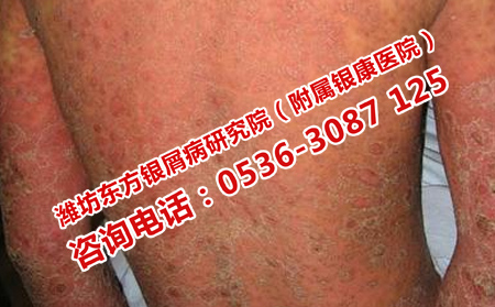 夏天降火銀屑病患者吃什么