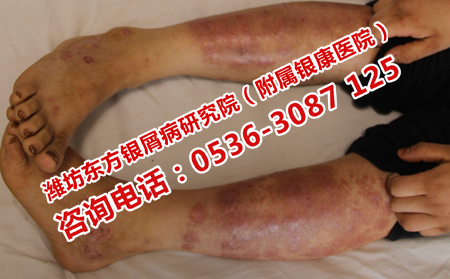 銀屑病的冬病夏治