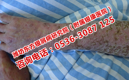 夏天治療牛皮癬理想的原因