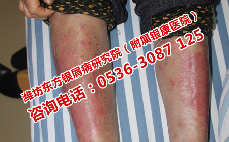 濟南銀屑病患者治療貴不