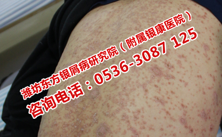 如何控制背部牛皮癬的病情