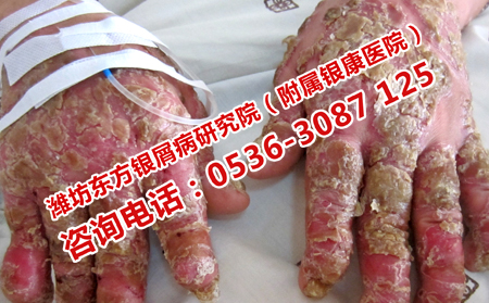 濟南牛皮癬醫院正規