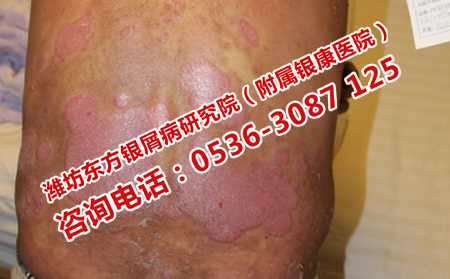 牛皮癬總是治不理想的原因