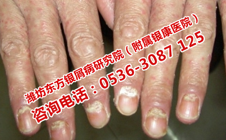 手背牛皮癬瘙癢擴散的治療