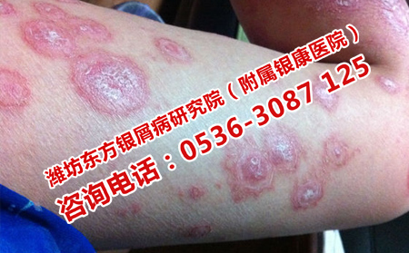 裸露位置牛皮癬的護理