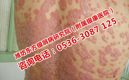 夏天護(hù)理膿皰型牛皮癬的技巧