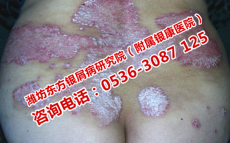 濟南看牛皮癬理想的醫生在哪里