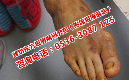 如何治療不嚴(yán)重的牛皮癬