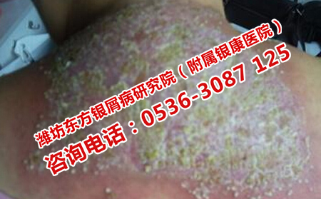 濟南治牛皮癬的理想醫院