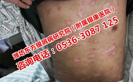 濟南牛皮癬醫院治牛皮癬多少錢