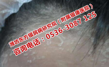 牛皮癬有掉頭發的癥狀嗎