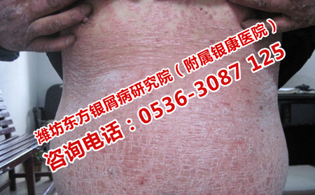 全身嚴重牛皮癬怎么治