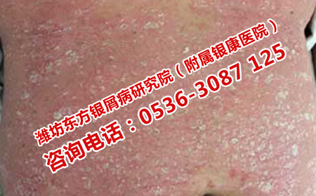 牛皮癬治療步驟