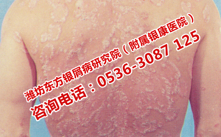 中醫治療濟南牛皮癬