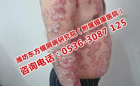 牛皮癬患者的日常護理