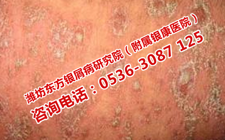 濟(jì)南牛皮癬患者如何預(yù)防