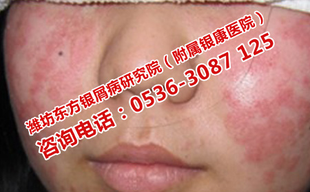 濟南治牛皮癬抗復發的醫院