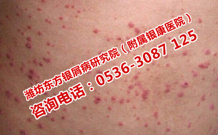 如何預(yù)防女性牛皮癬復(fù)發(fā)