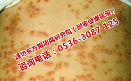 防止牛皮癬轉型的方法