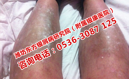 濟南專門治療男性牛皮癬的醫院