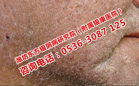 銀屑病能不能治理想呢