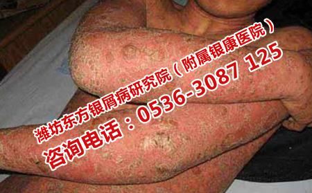 胳膊上擴散的牛皮癬如何治療