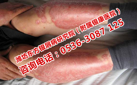 如何緩解關節型牛皮癬的痛苦