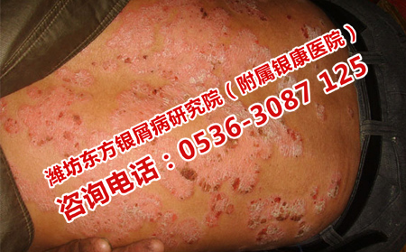 uvb治療銀屑病如何