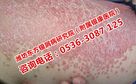 濟南哪里有治療牛皮癬的