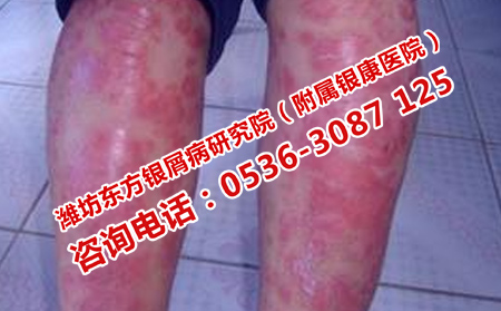 專門治療牛皮癬的醫院