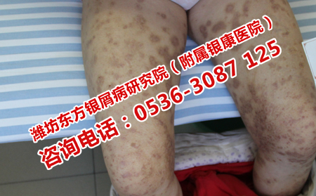 中醫治療牛皮癬的有效方法