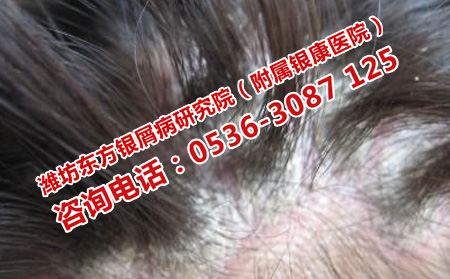 長清能治理想牛皮癬嗎
