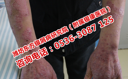 鋼城銀屑病多久能全理想